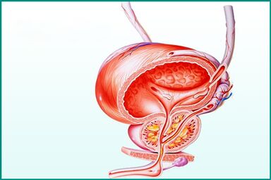 Eine Entzündung der Prostata bei akuter Prostatitis stellt eine Einschränkung beim Sex dar