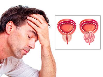 Die Symptome einer Prostatitis beunruhigen Männer.