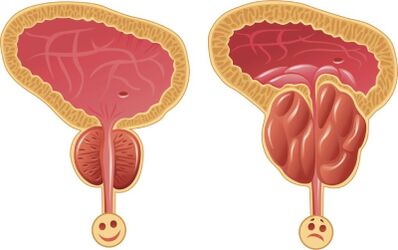 Gesunde und entzündete männliche Prostata