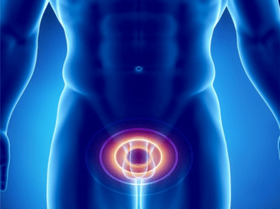 Prostatitis-Entzündung der Prostata bei einem Mann.
