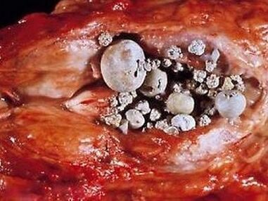 Steine ​​in der Prostata bei kalkhaltiger Prostatitis.