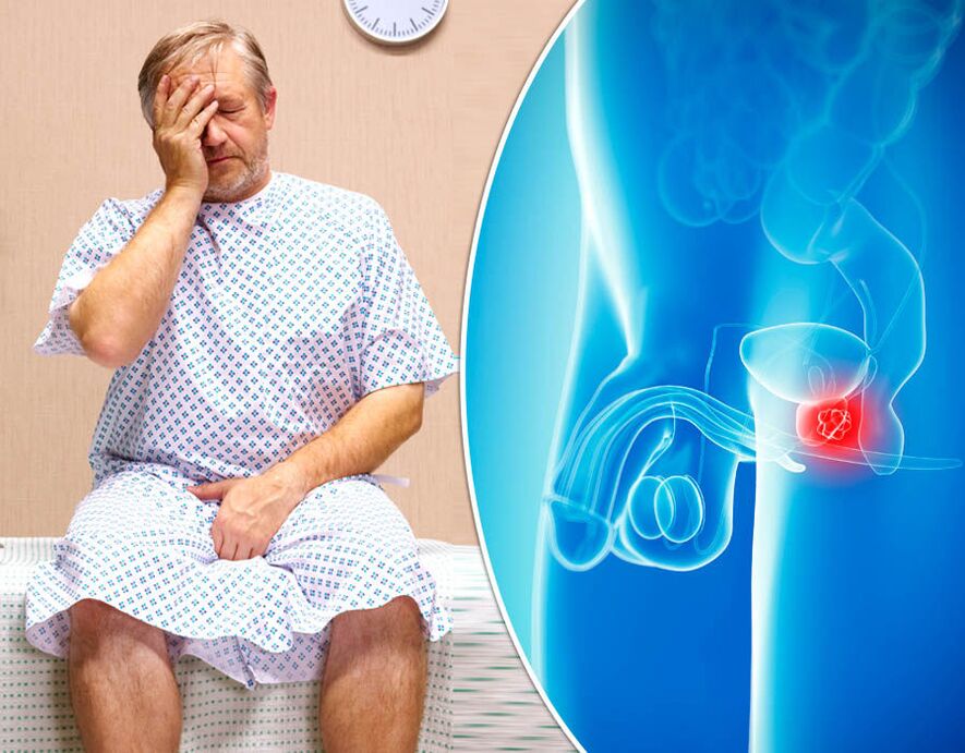 Bei einem Mann mit Prostatitis wird eine Krankheit diagnostiziert. 