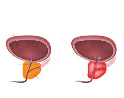Normale und entzündete Prostata