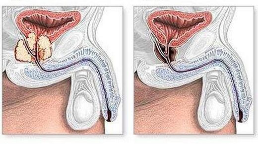 Vor und nach der chirurgischen Behandlung der chronischen Prostatitis. 